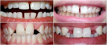 Niềng răng thưa 1 hàm giá bao nhiêu? Chi phí tại nha khoa
