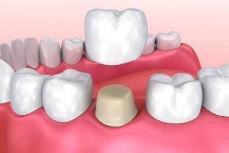 Phục hình răng sứ Titan